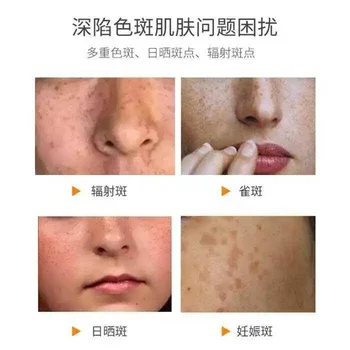 Freckle-Odstranjevanje Krema Kožo Razbarvanje Zbledi Krema za Izboljšanje Kože Problem Zob Virov Energije Anti-spot Krema za Gladko Kožo